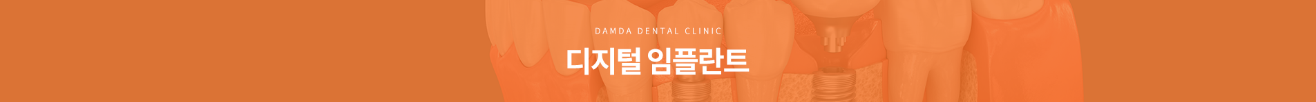 디지털 임플란트
