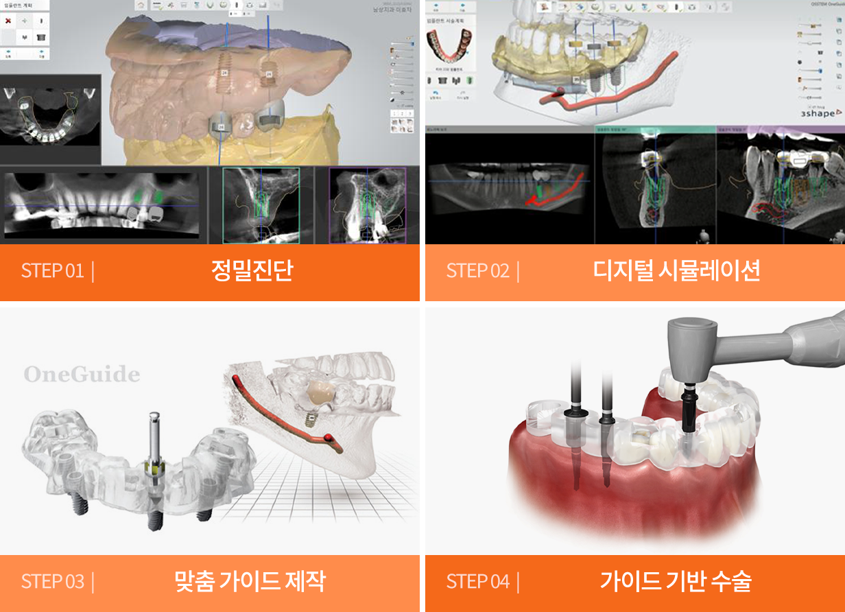 오스템 원가이드 임플란트